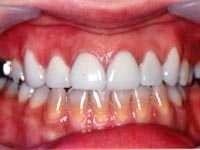 歯の変色・すきっ歯・治療前